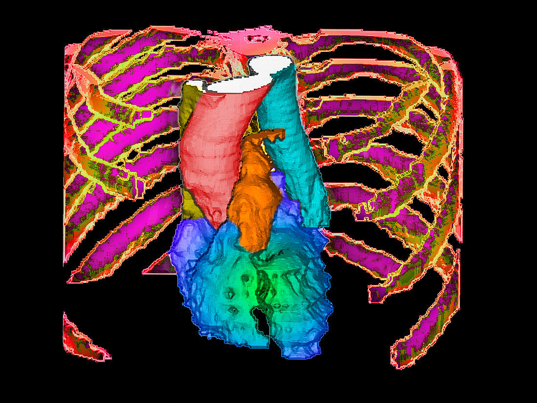 Coloured 3-D CT scan of healthy heart in ribcage