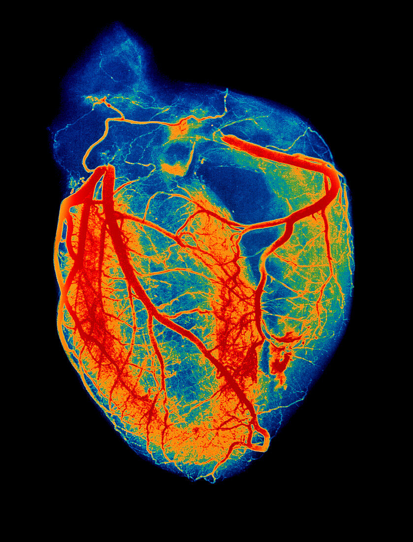 Arteriogram of arteries of healthy heart