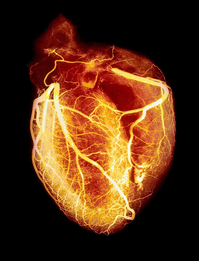 Coloured arteriogram of arteries of healthy heart