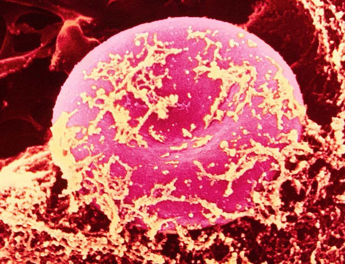 Coloured SEM of red blood cell covered in fibrin