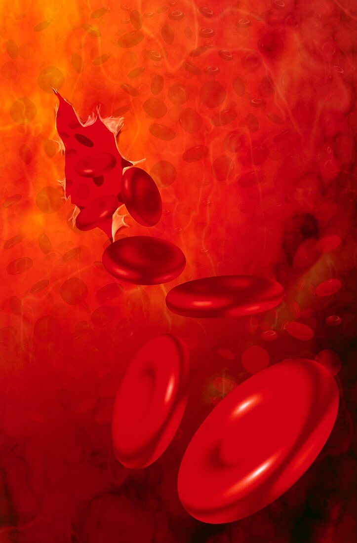 Artwork of red blood cells from torn blood vessel