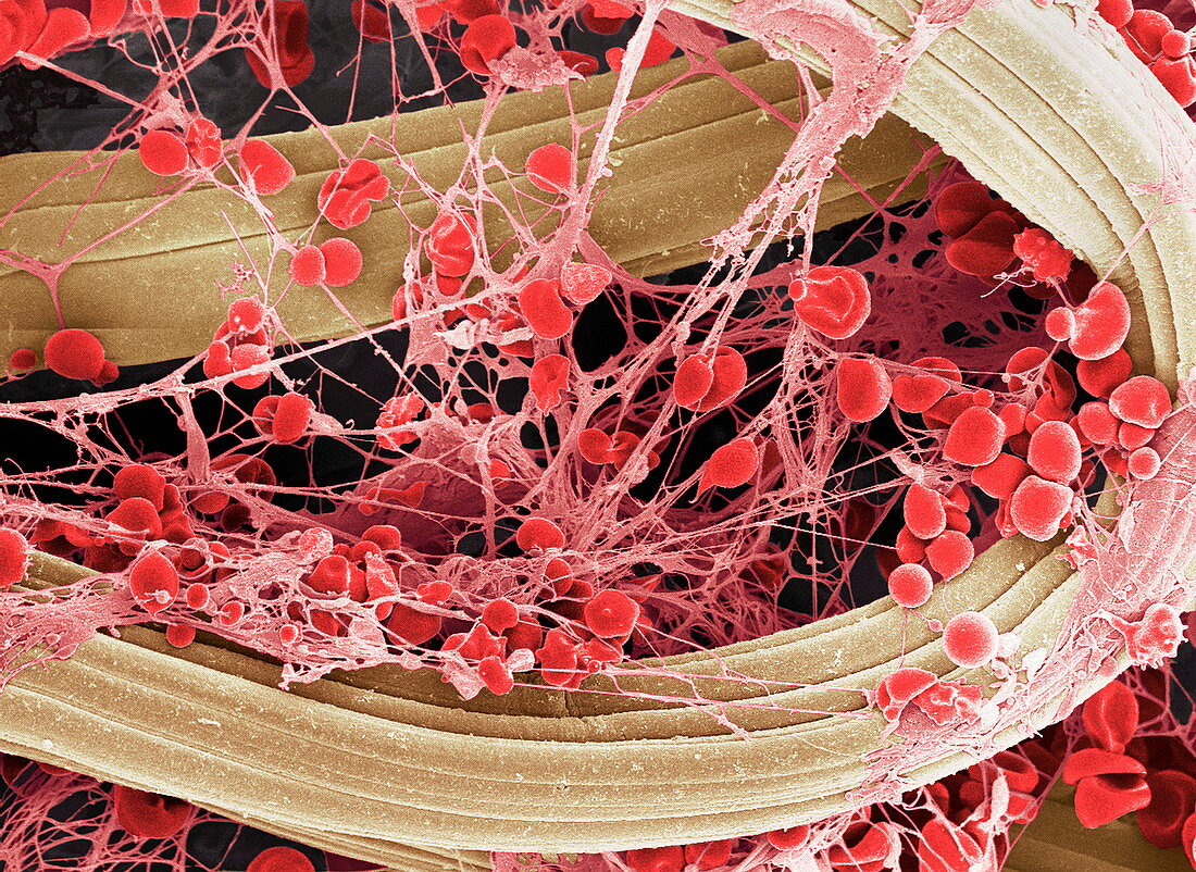 Blood clot on plaster,SEM