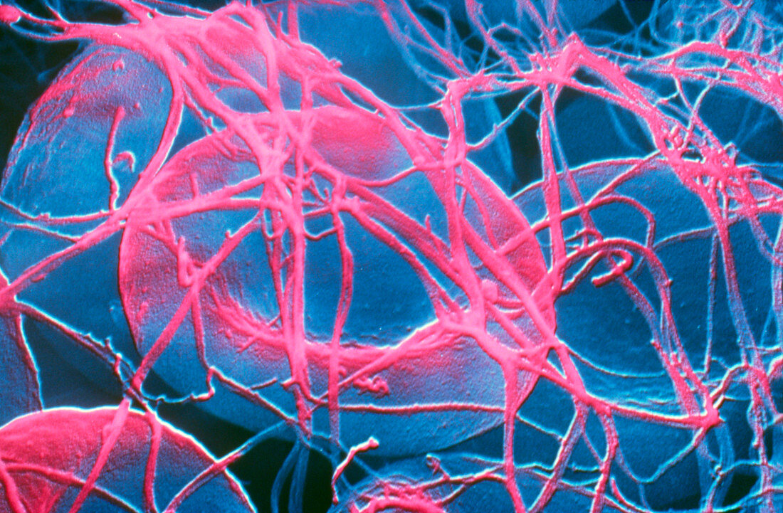 False-colour SEM of a human blood clot