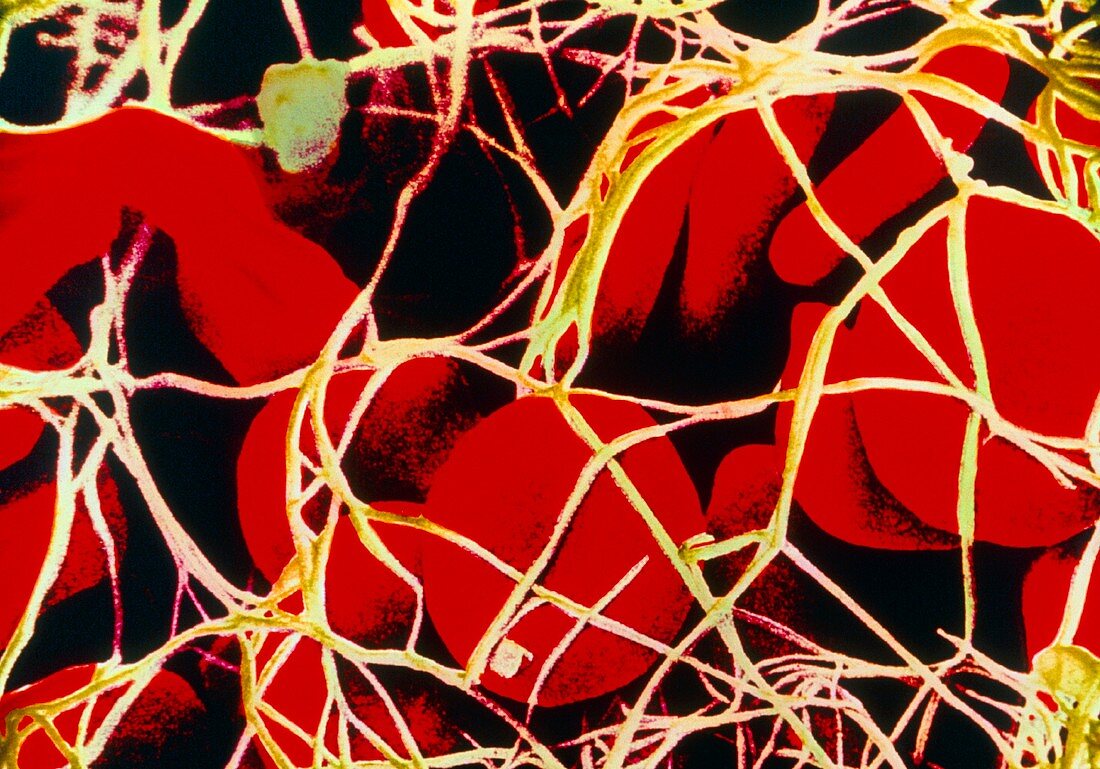 Coloured SEM of red blood cells tangled in fibrin