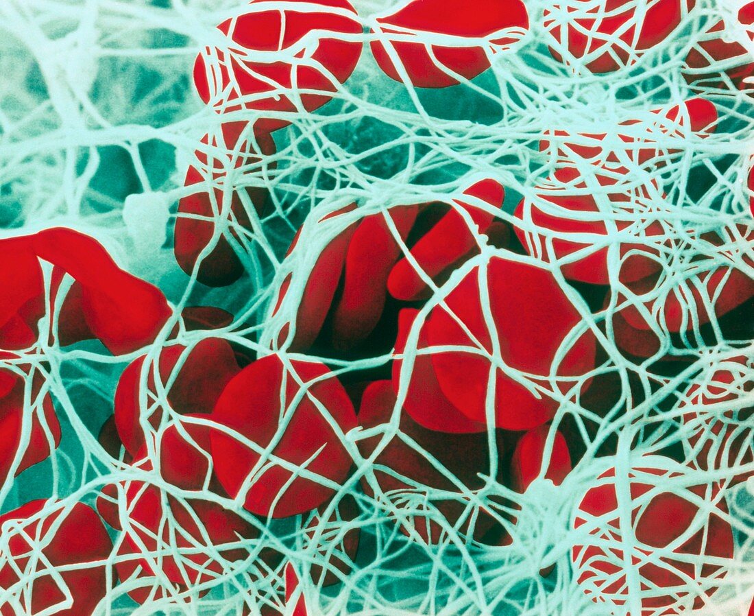 Coloured SEM of red blood cells forming a clot