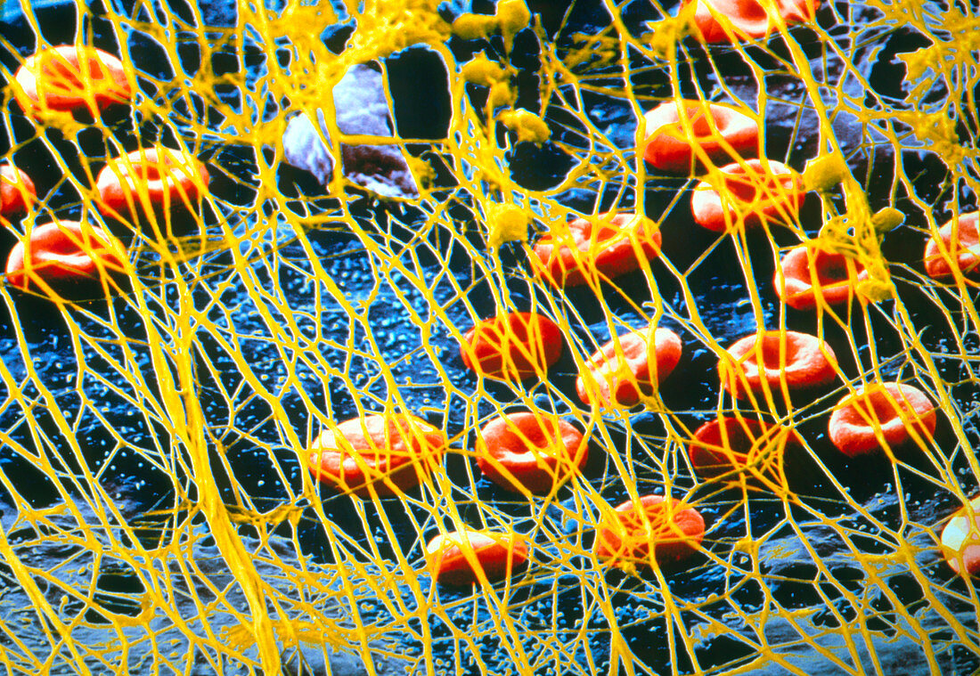 Coloured SEM of a blood clot due to an injury