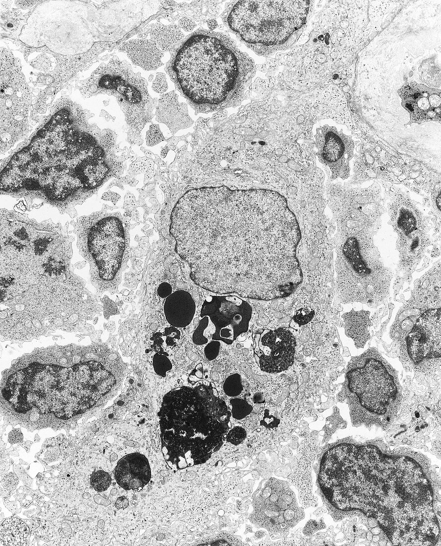 TEM of a macrophage from a human tumour