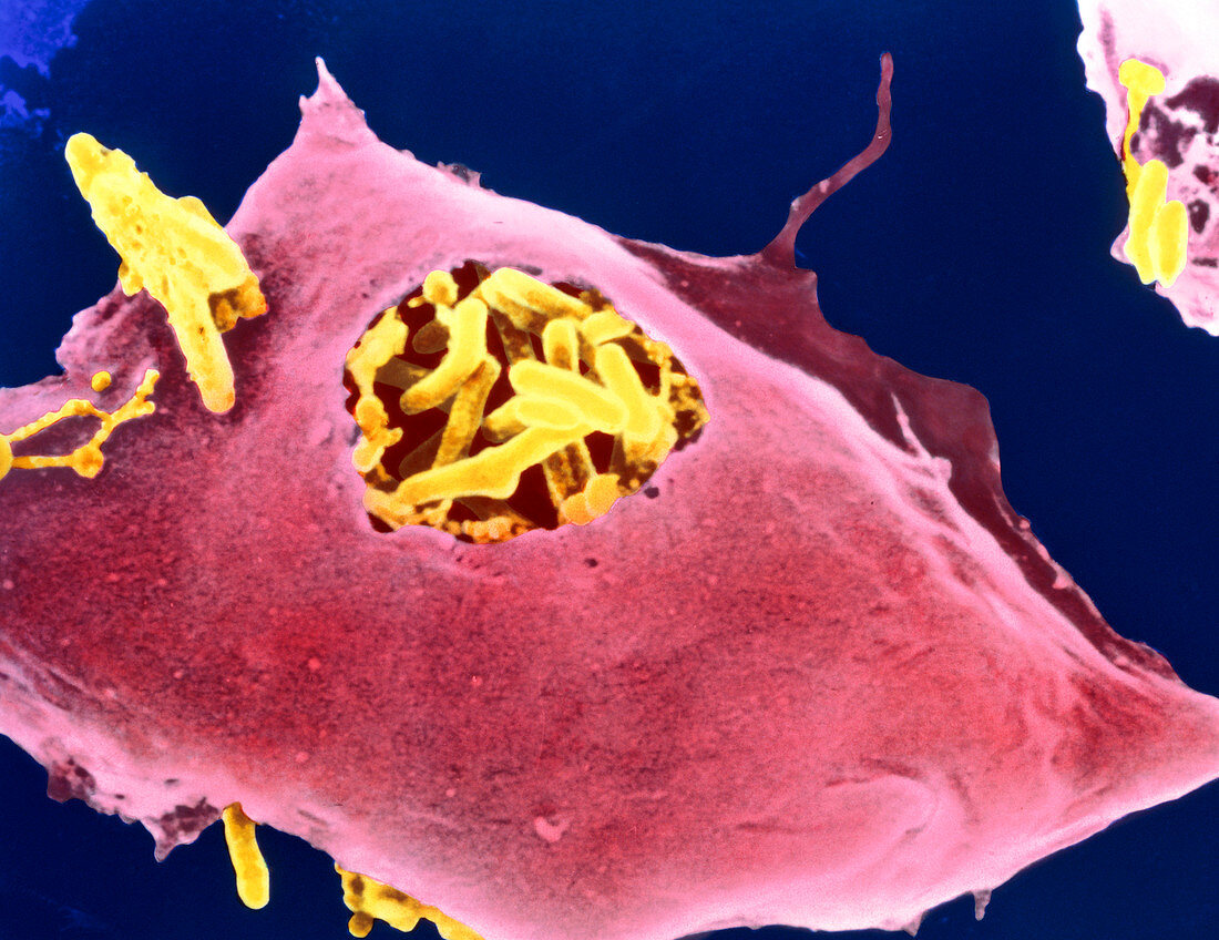 Macrophage eating tuberculosis bacteria