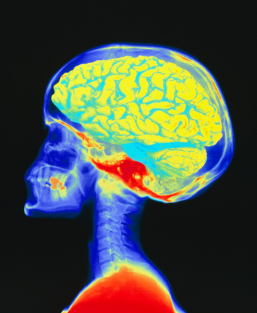 Brain superimposed on colour X-ray of human skull