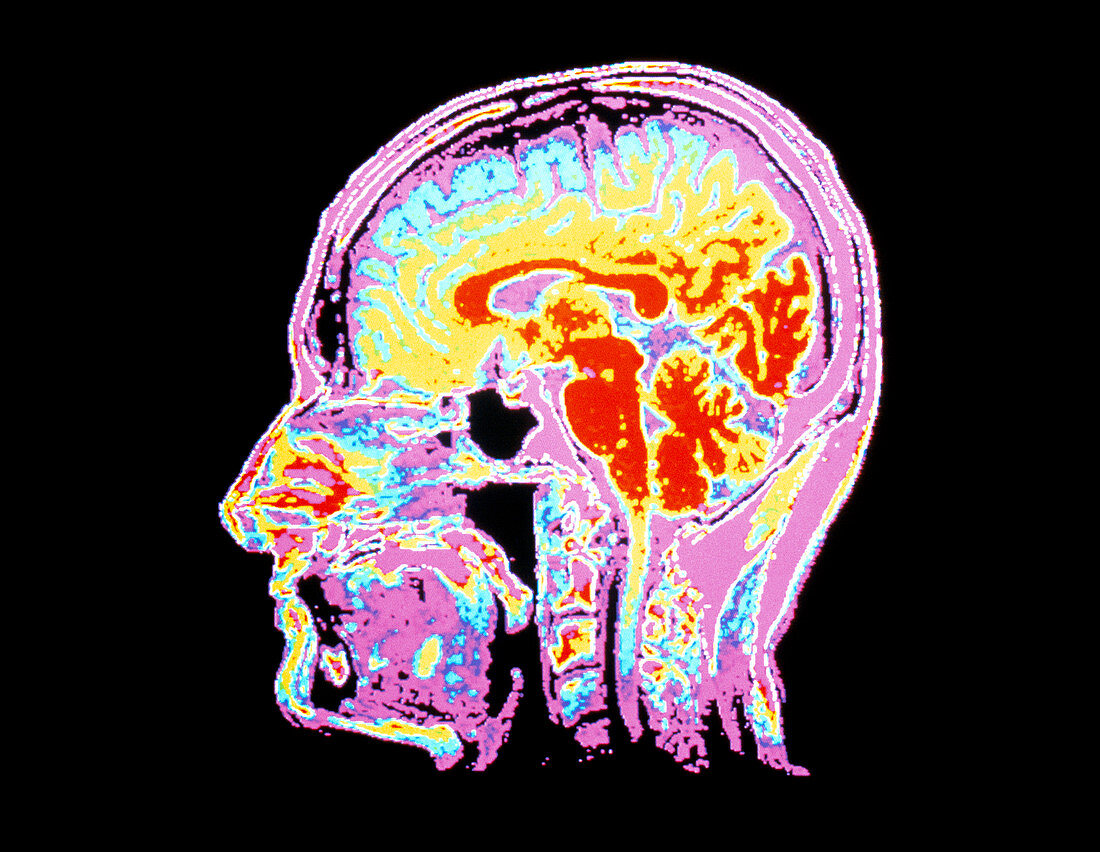 Human head,MRI scan