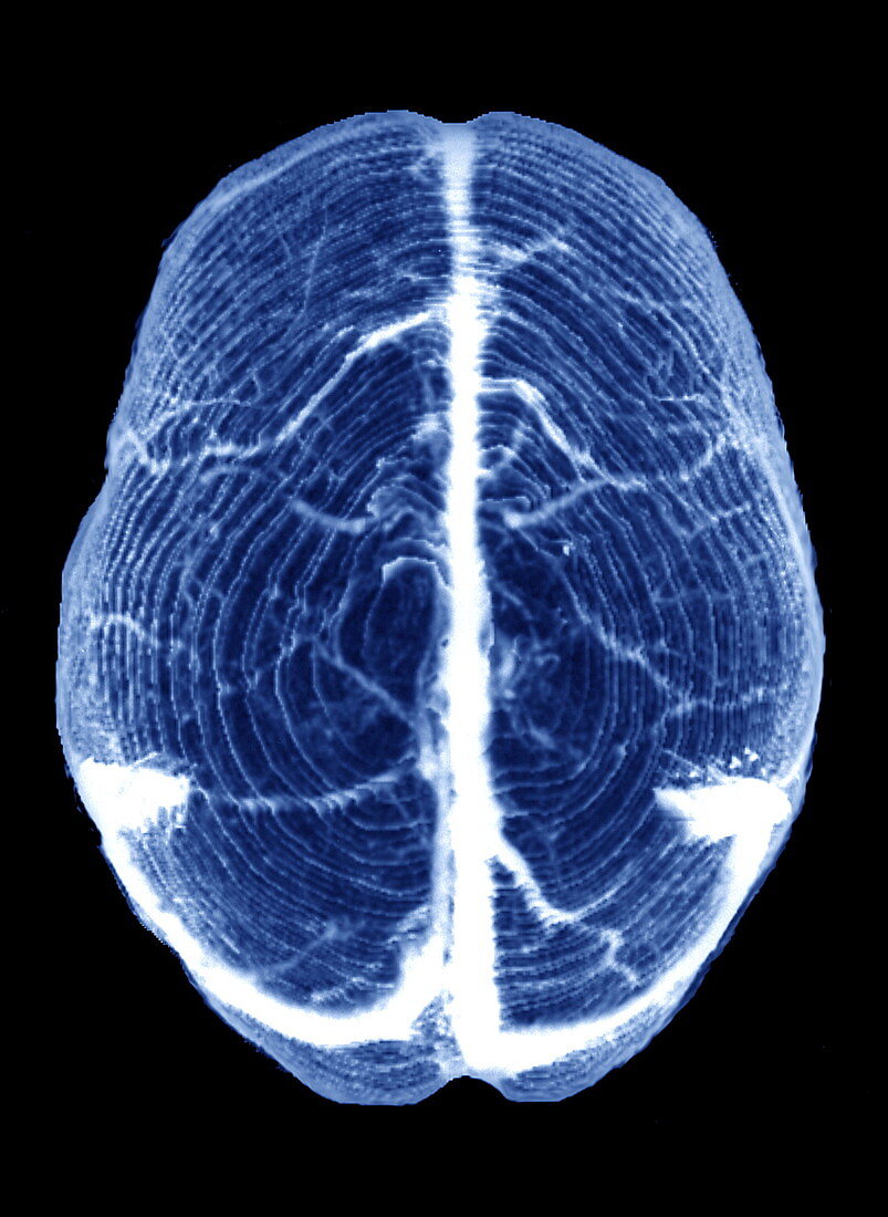 Venous sinuses in brain,CT scan