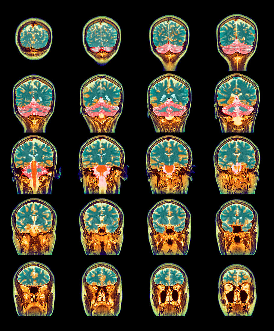 Healthy brain,MRI scans