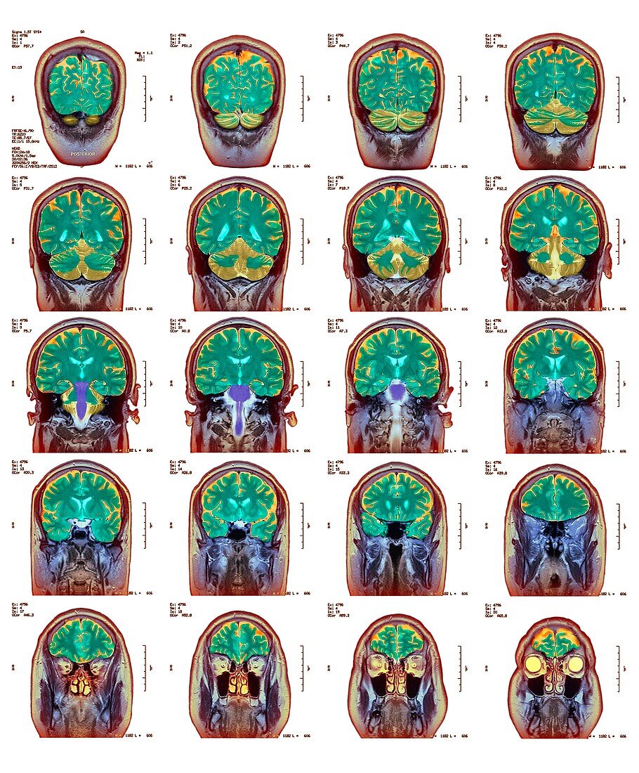 Healthy brain,MRI scans