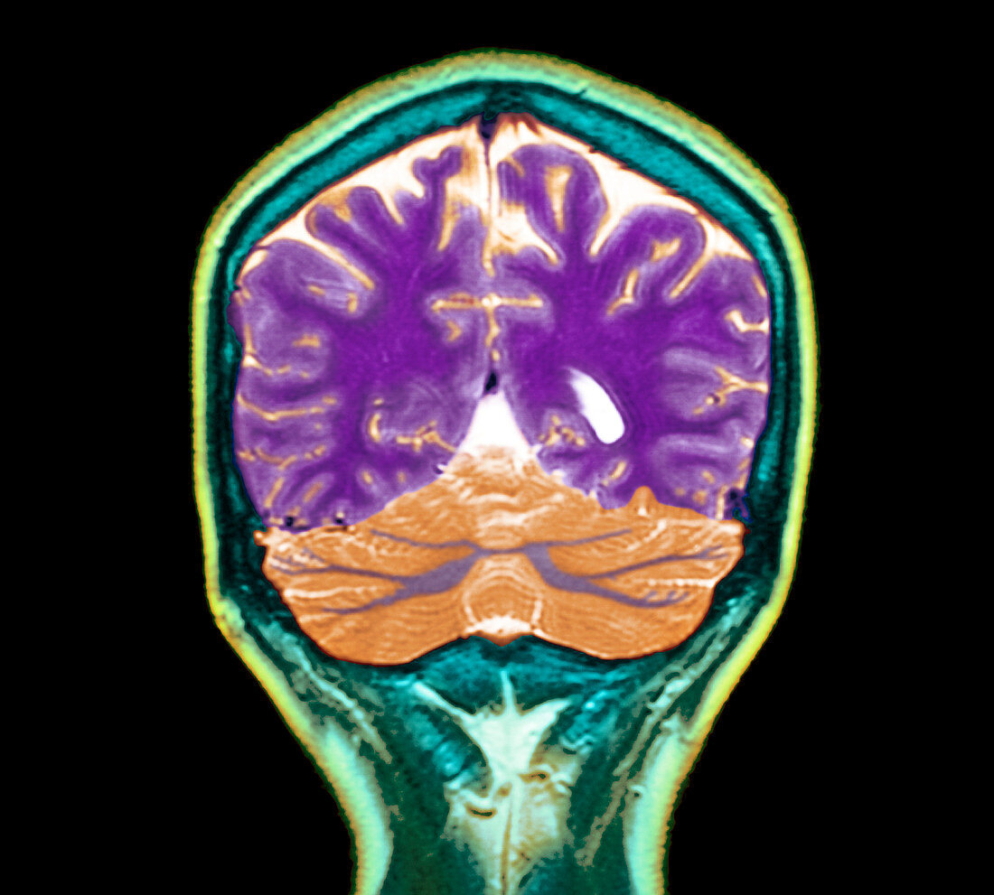 Healthy brain,MRI scan