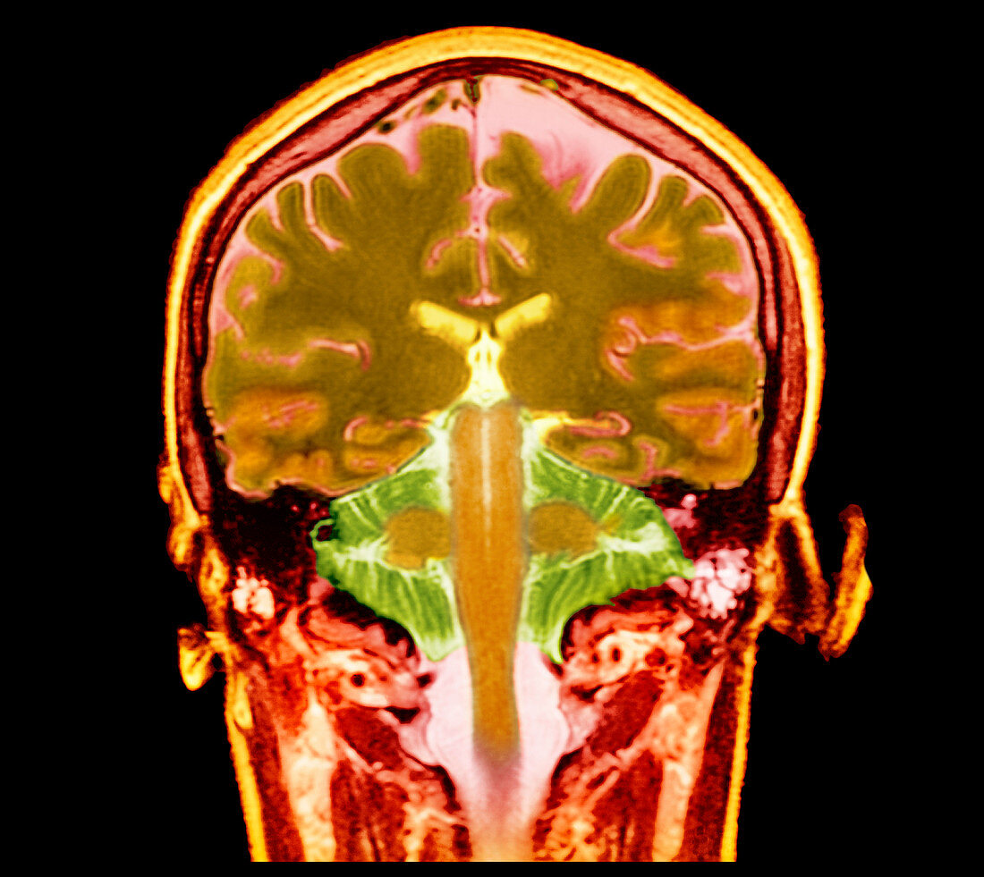 Healthy brain,MRI scan