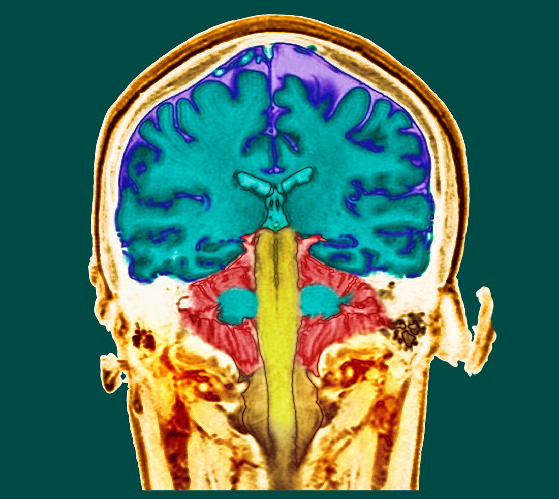 Healthy brain,MRI scan