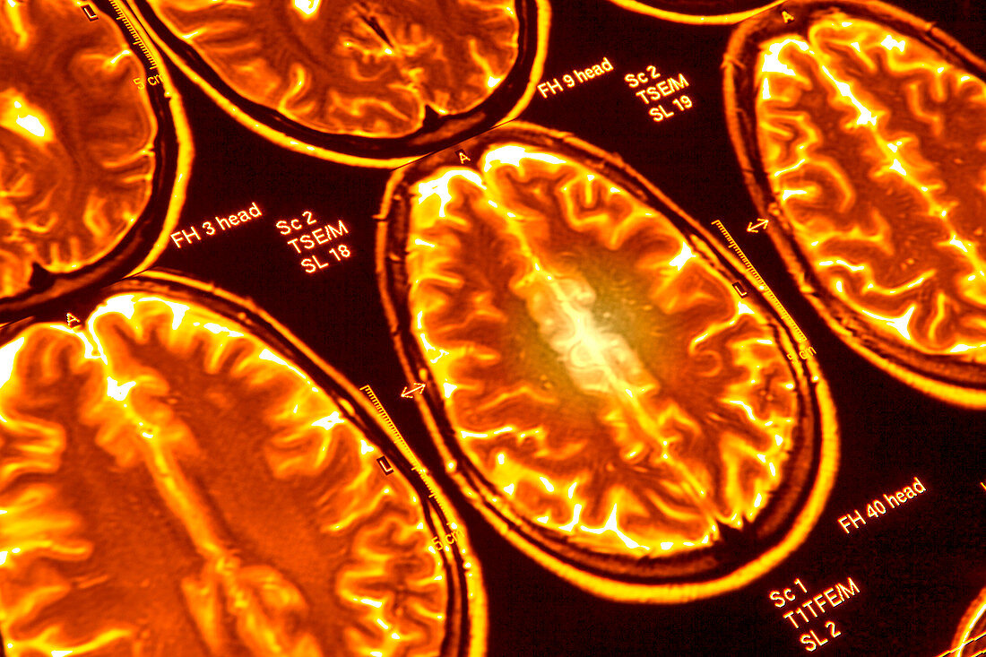 Brain scans,MRI scans