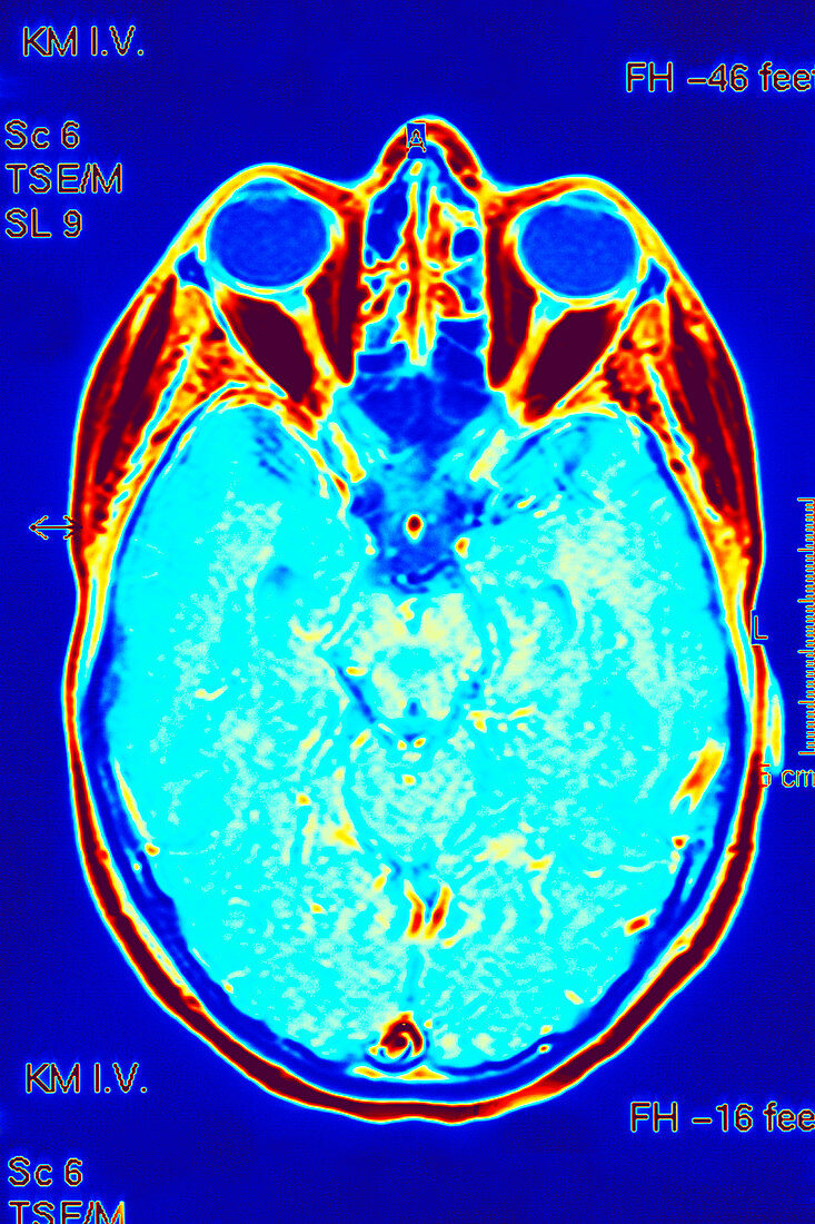 Brain scan,MRI scan