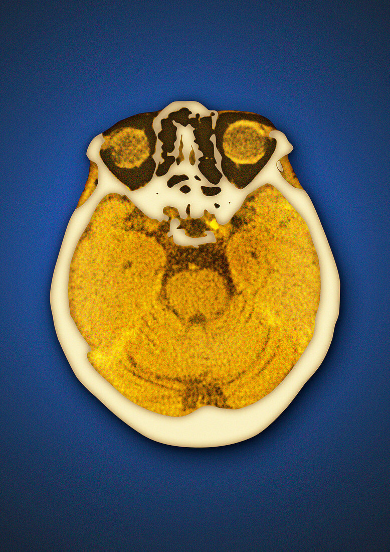 Healthy brain and eyes,CT scan