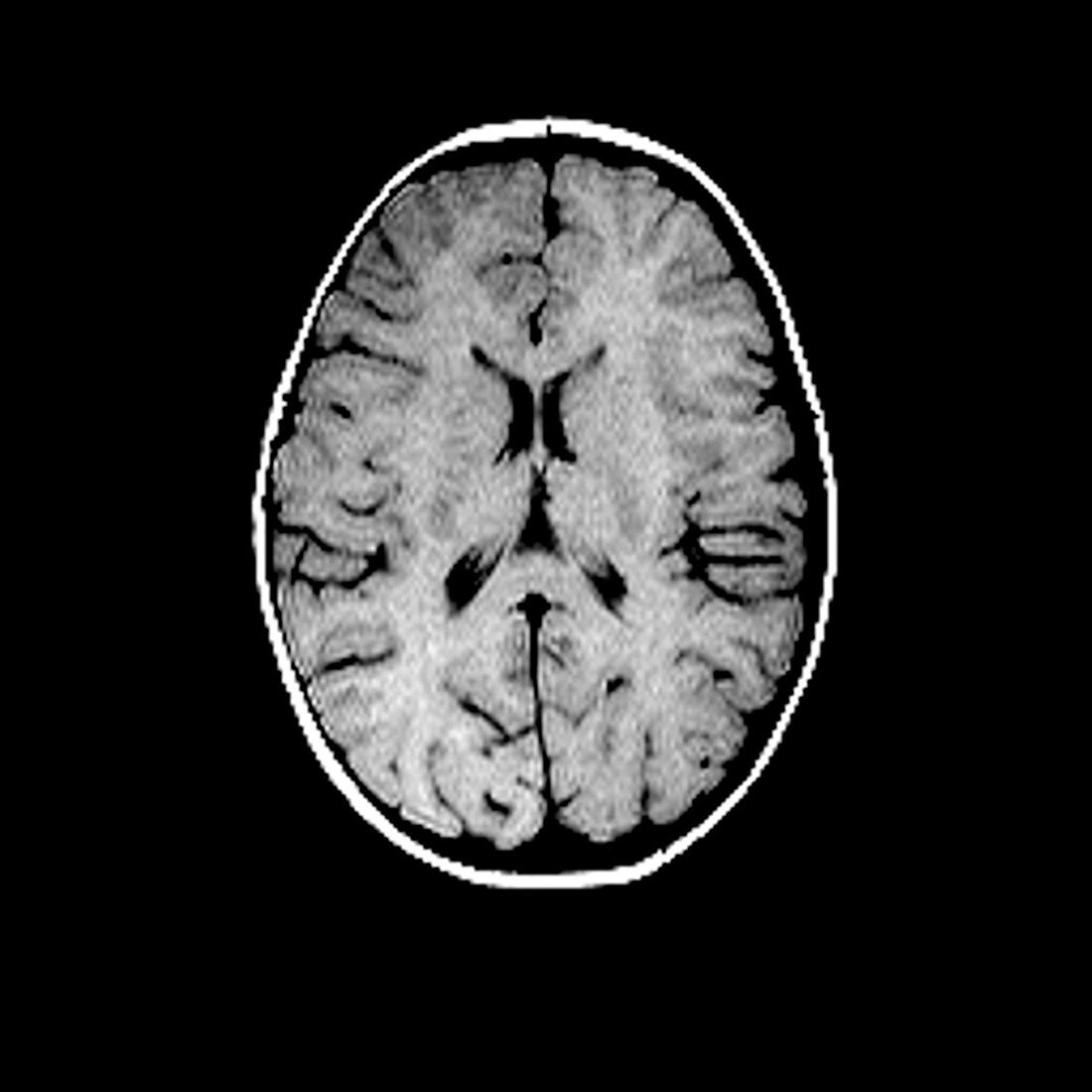 Child's brain,MRI scan