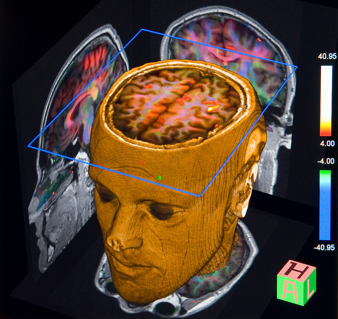 Advanced MRI brain scans