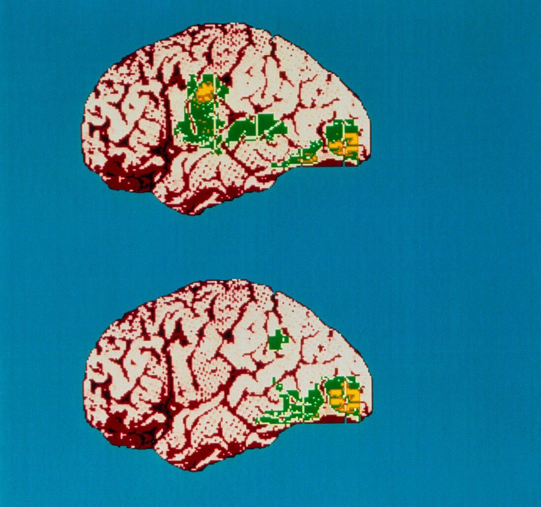 Colour PET brain scan when reading aloud/silently