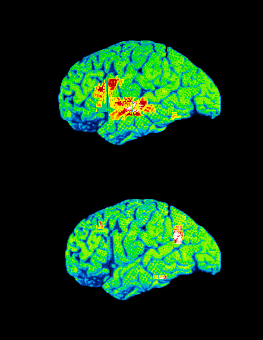 Coloured PET brain scans when recognising words