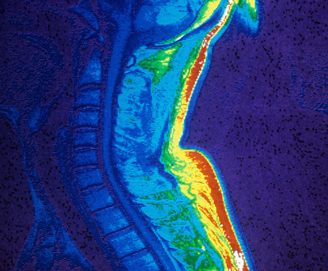 MRI scan of the spinal cord