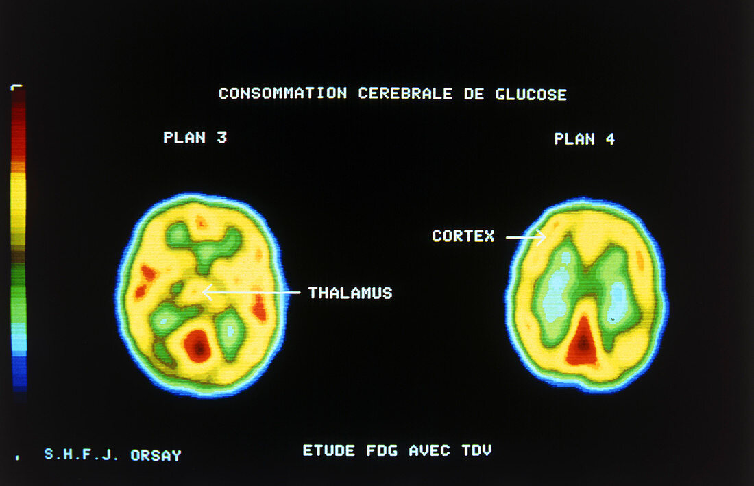 Two axial PET scans of the human brain