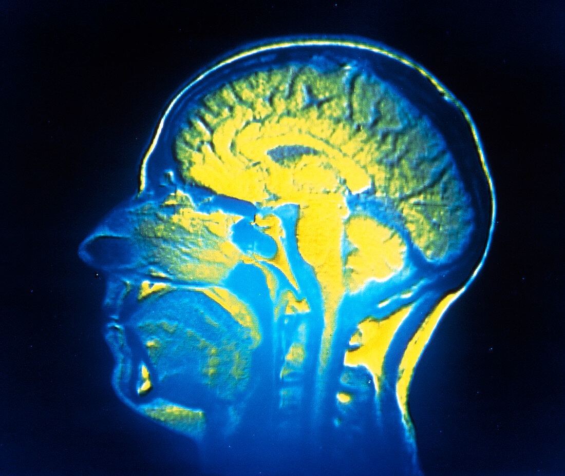 Nuclear magnetic resonance image of the human head