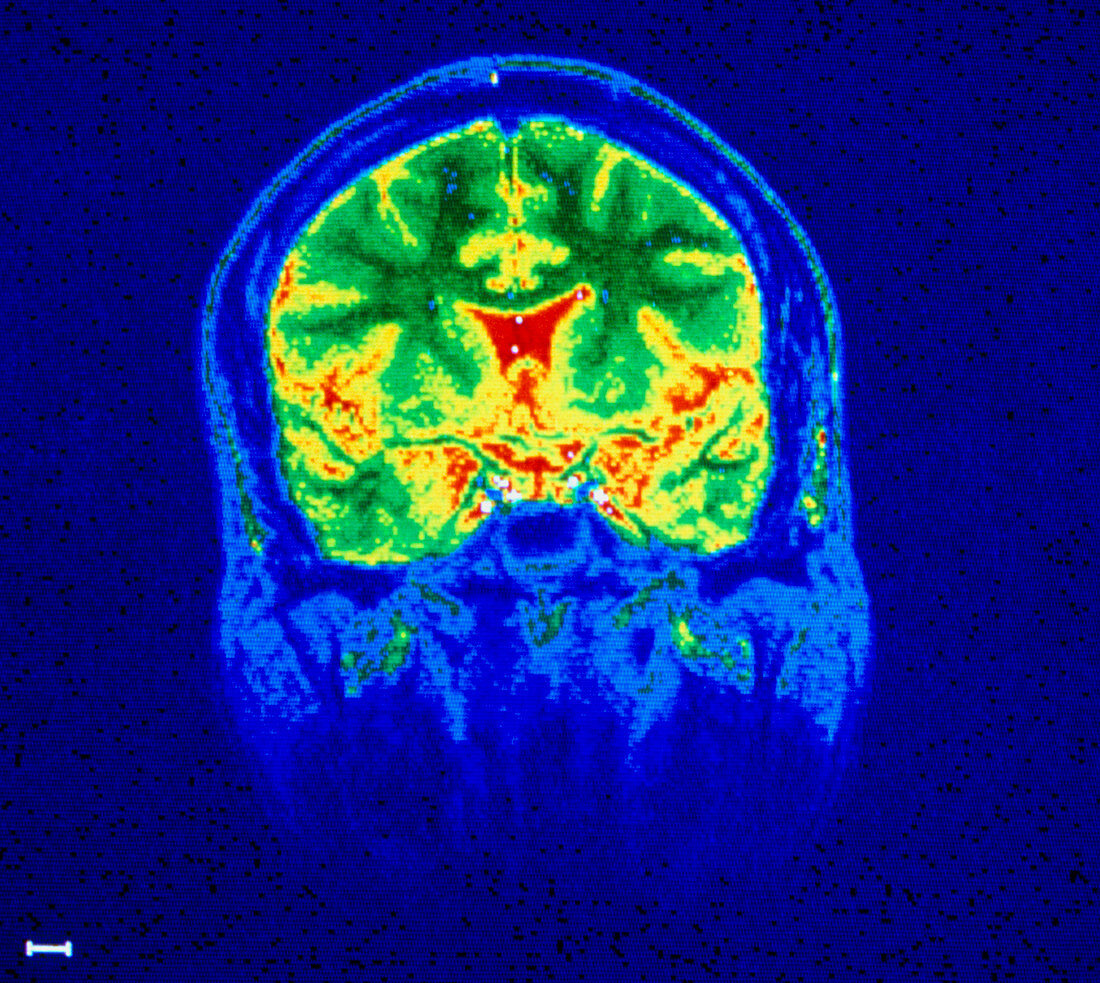 False-colour frontal NMR scan of a child's head