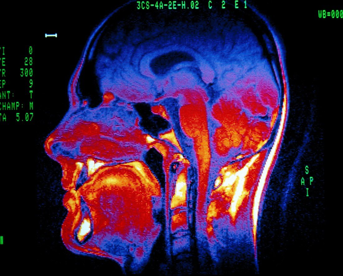 Normal NMR brain scan