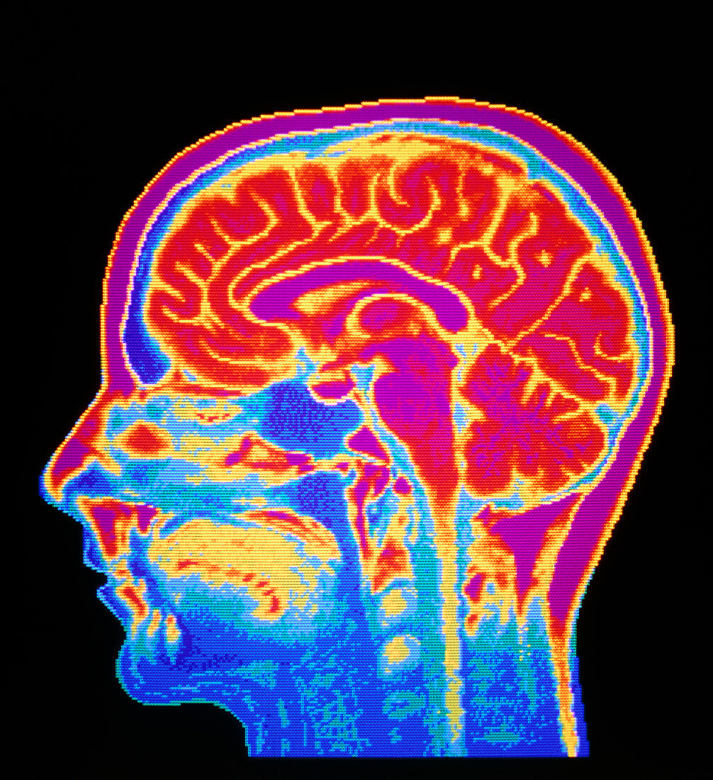 MRI scan of normal brain