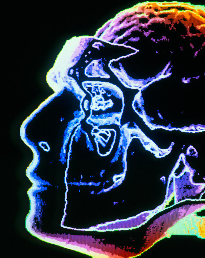 F/col 3-D CT scan of human brain in head,profile