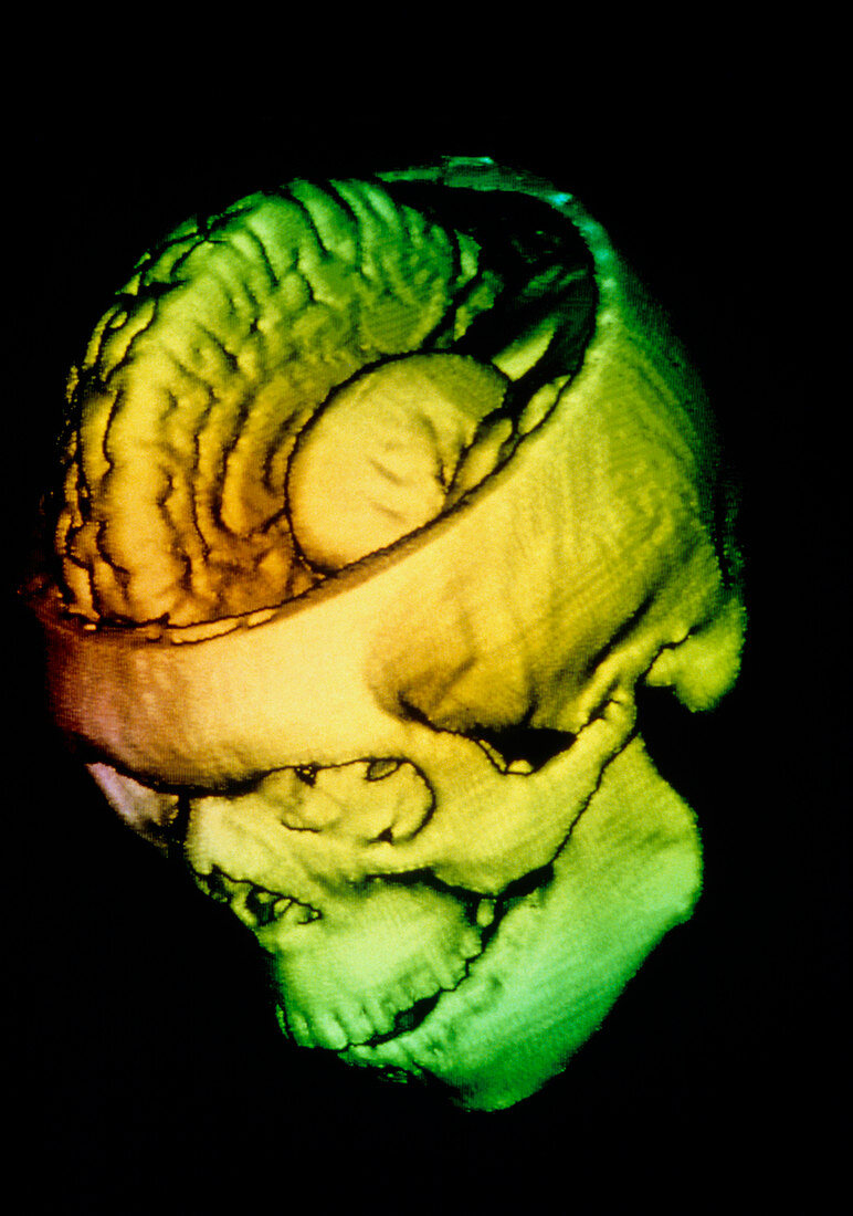 Coloured 3-D CT scan of opened skull and brain