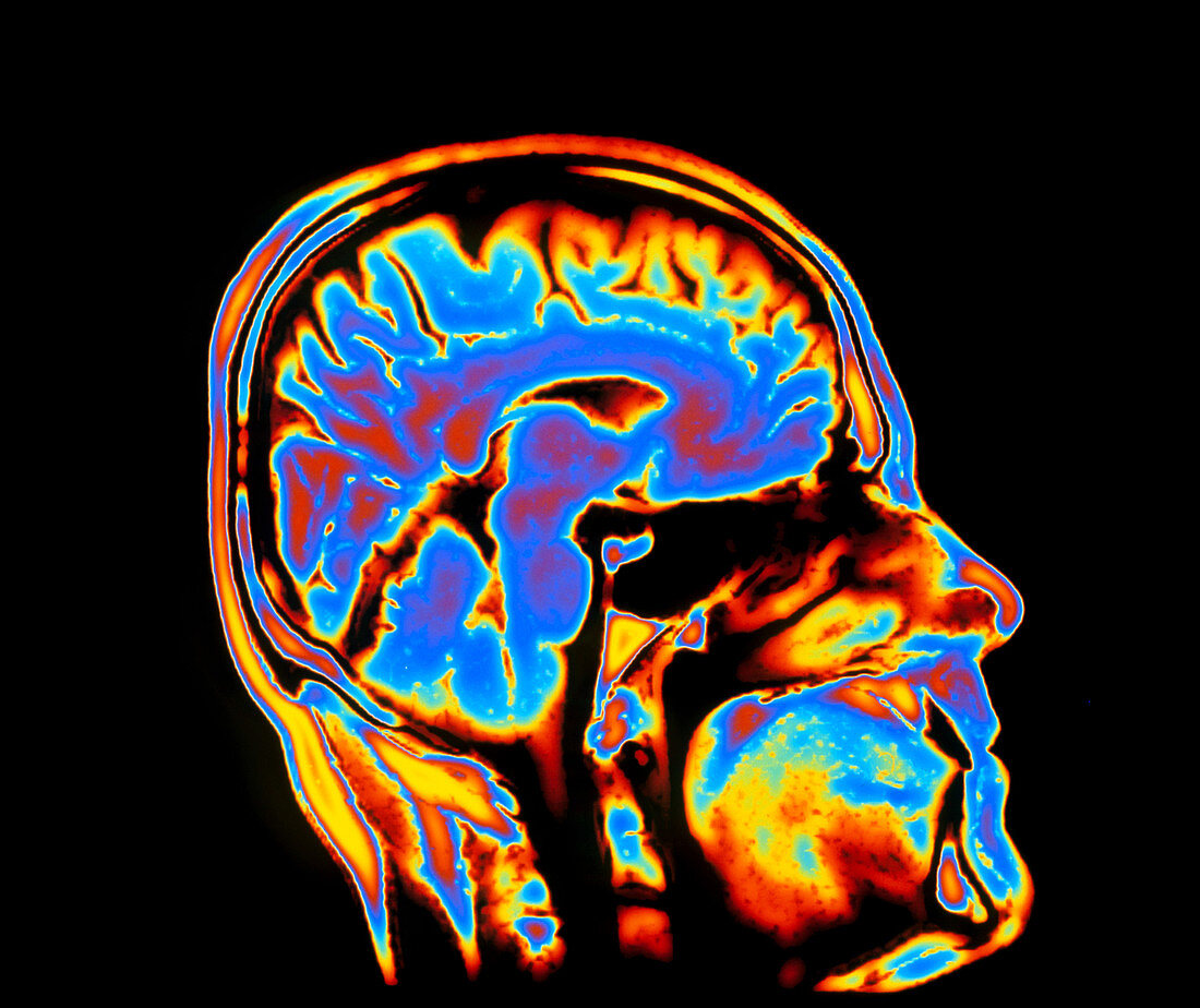 Coloured CT scan of the brain in head (side view)