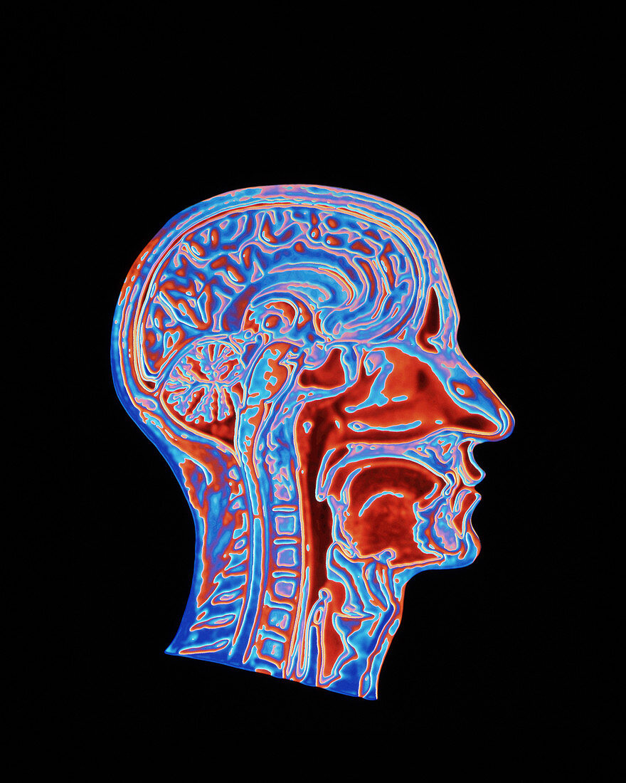 Coloured CT scan of a head showing a healthy brain