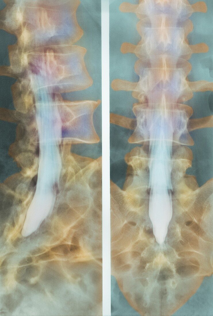 Normal spinal cord,X-ray