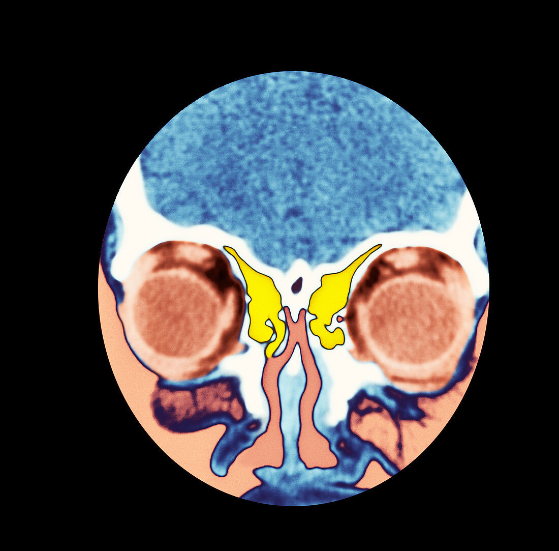 Nose and sinuses,CT scan