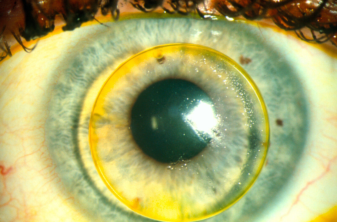 Macrophoto of human eye wearing a contact lens