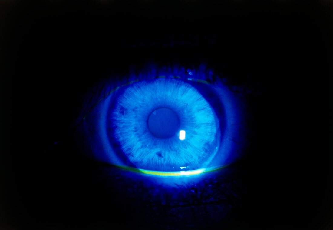 Normal eye highlighted with fluorescin under UV