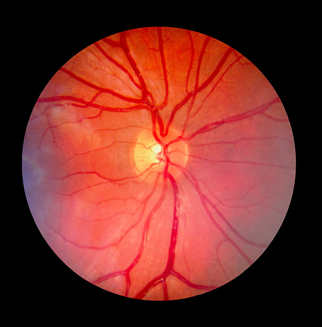 Normal retina of eye