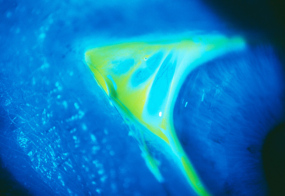 Medial canthus of eye highlighted with fluorescin