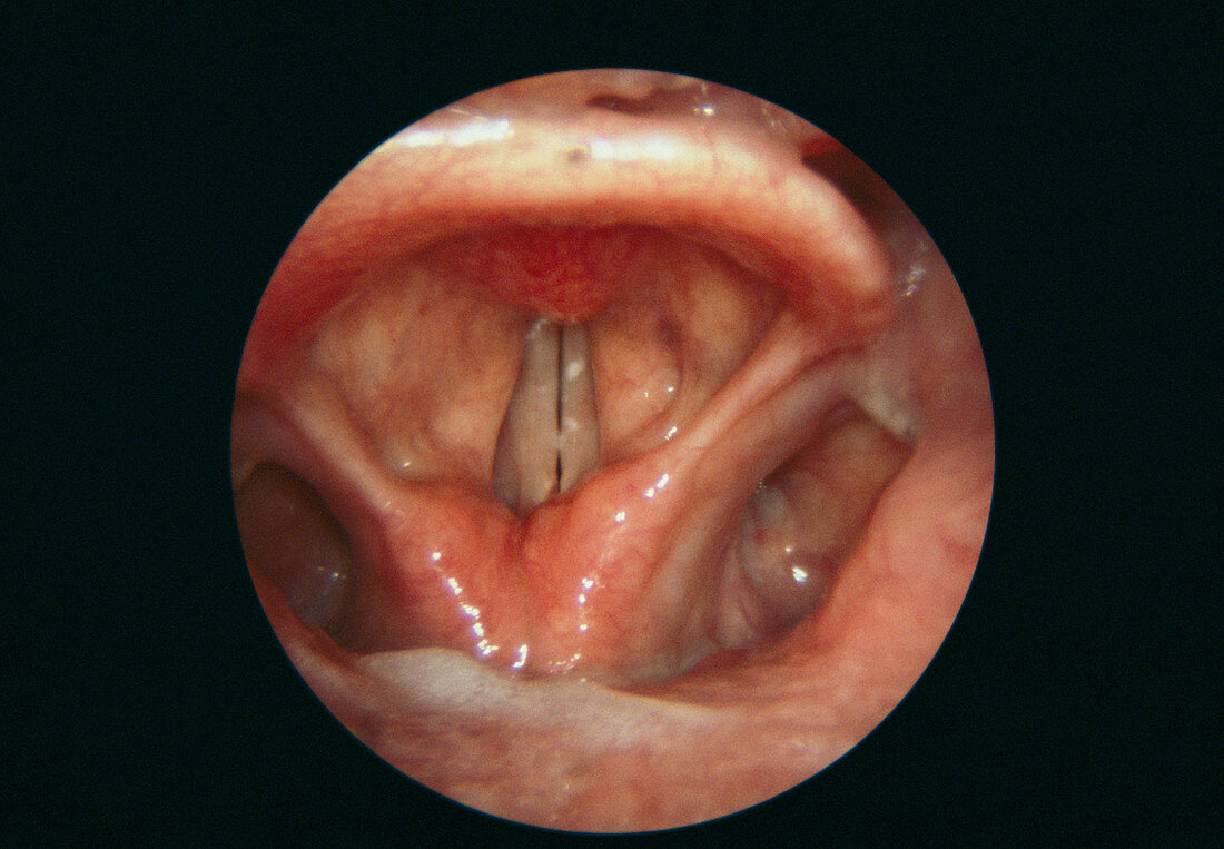 Closed larynx