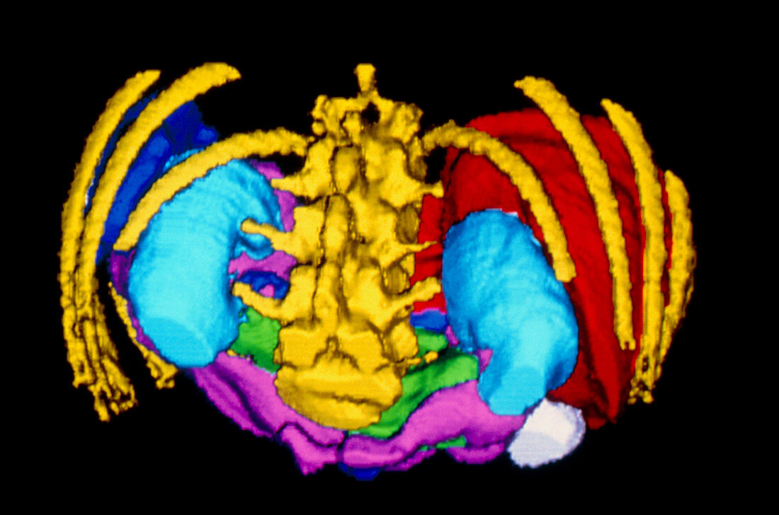 False-colour 3-D CT scan of digestive viscera
