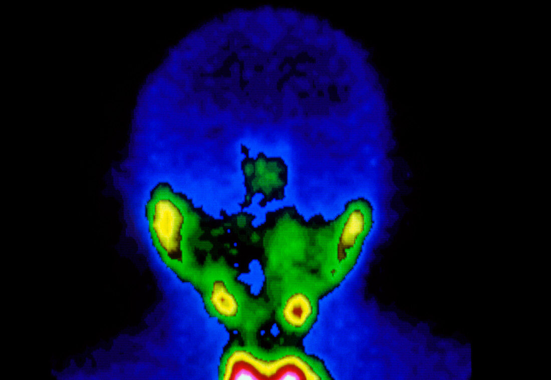 F/colour gamma scan of salivary and thyroid glands