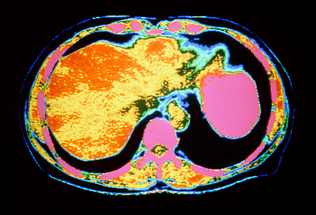 Coloured CT scan of abdomen with liver & stomach