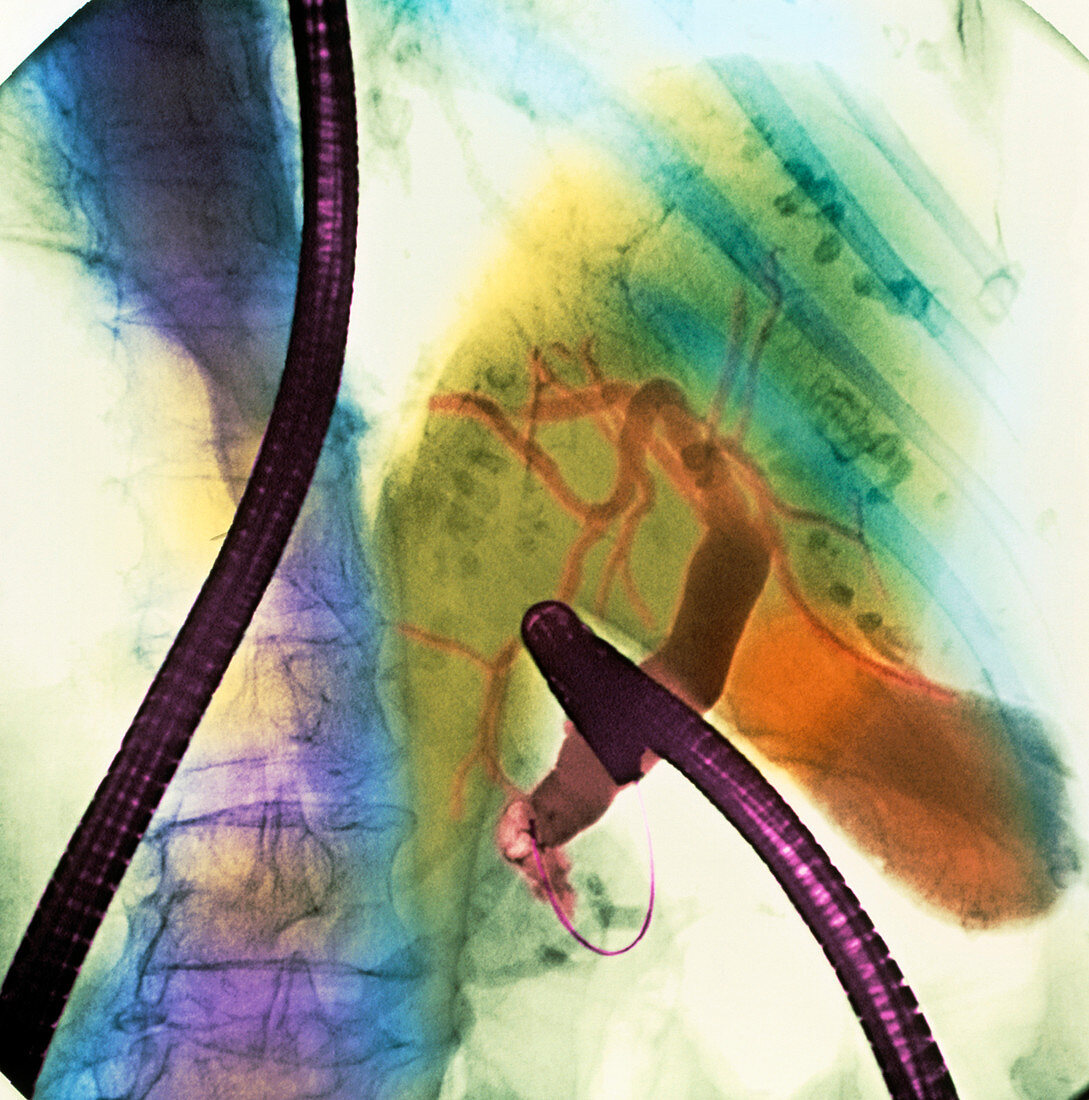 Coloured X-ray of gall bladder during endoscopy
