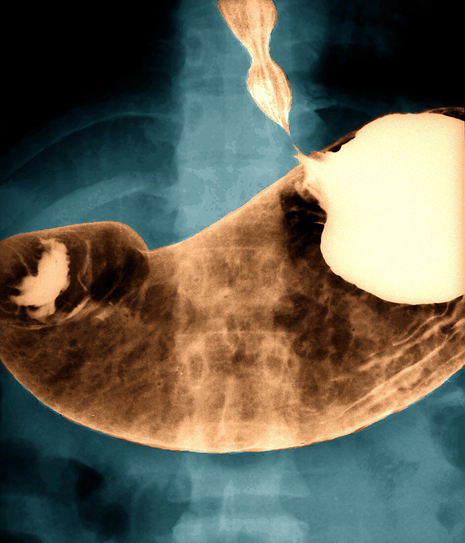 Stomach,X-ray