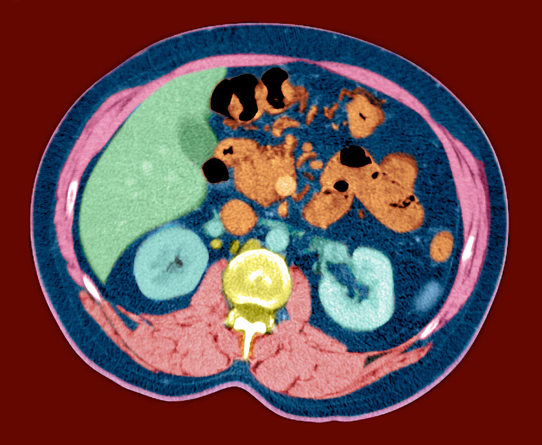 Kidneys,abdominal CT scan